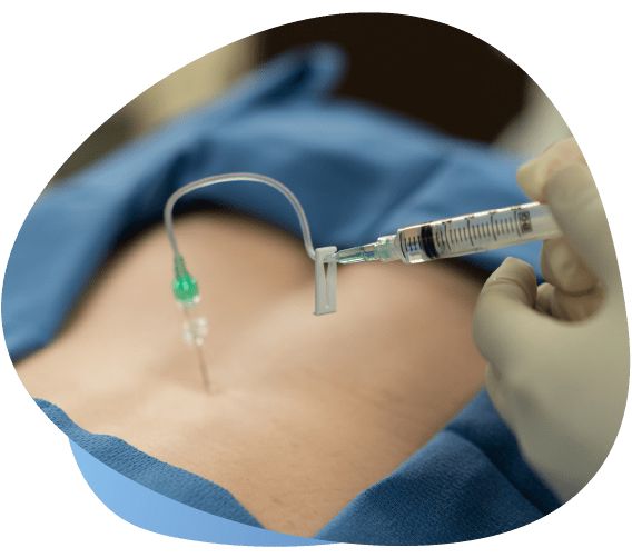 Epidural Nerve Block Injections in Indiana