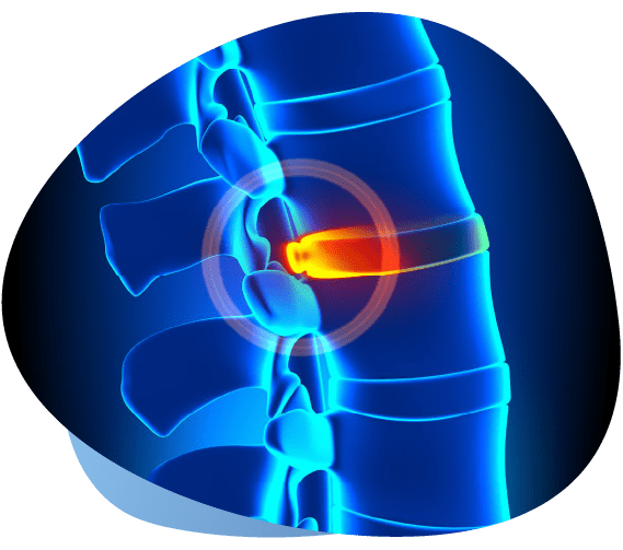 Illustration Of Diagnostic Discography In Indiana For Spinal Discs