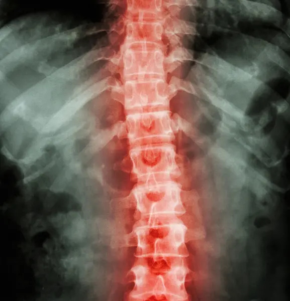 X-ray Of Thoracic Spine With Pain